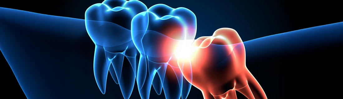 Dentist Canoga Park CA Dental Technology A digital illustration of teeth, with one being red, contrasting with the blue depiction of the other healthy teeth.