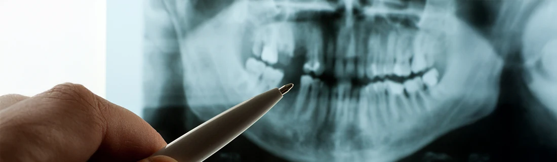 Dentist Canoga Park CA Digital X-Rays A hand holds a pen, pointing towards a panoramic dental X-ray showing upper and lower jaws with teeth.