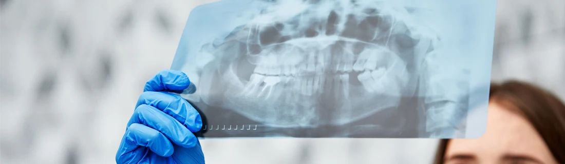 Dentist Canoga Park CA Panoramic X-Rays A person wearing blue medical gloves holds up a panoramic dental X-ray, displaying both the upper and lower jaws and teeth.